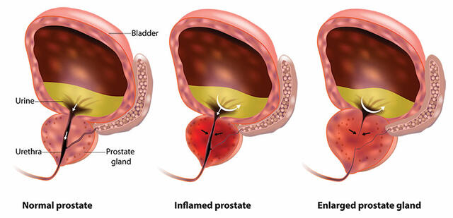 normal-inflamed-enlarged-prostate-difference