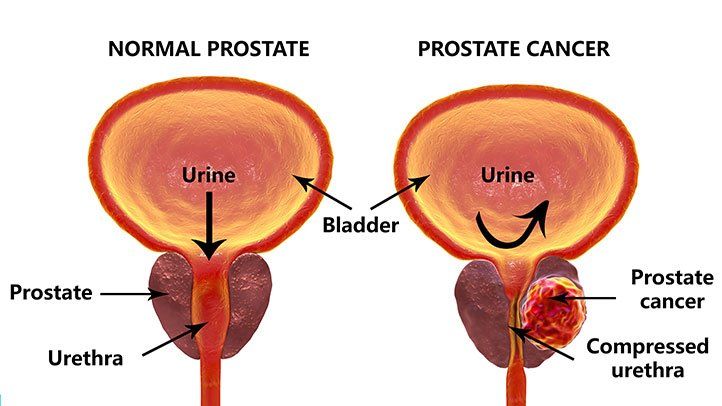 Prostate-Cancer